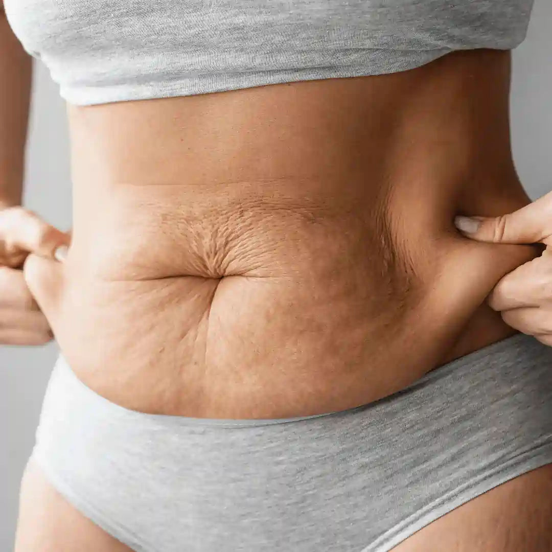 Is It Normal to Have Loose Skin After Pregnancy Epsom?