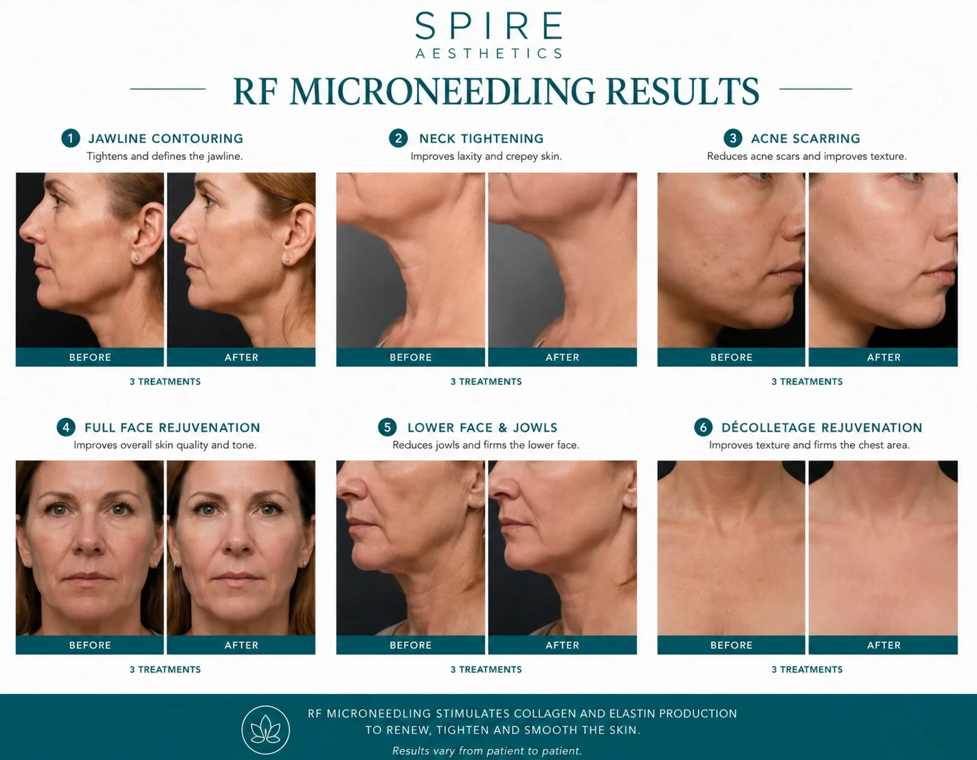 RF Microneedling Skin tightening Epsom results
