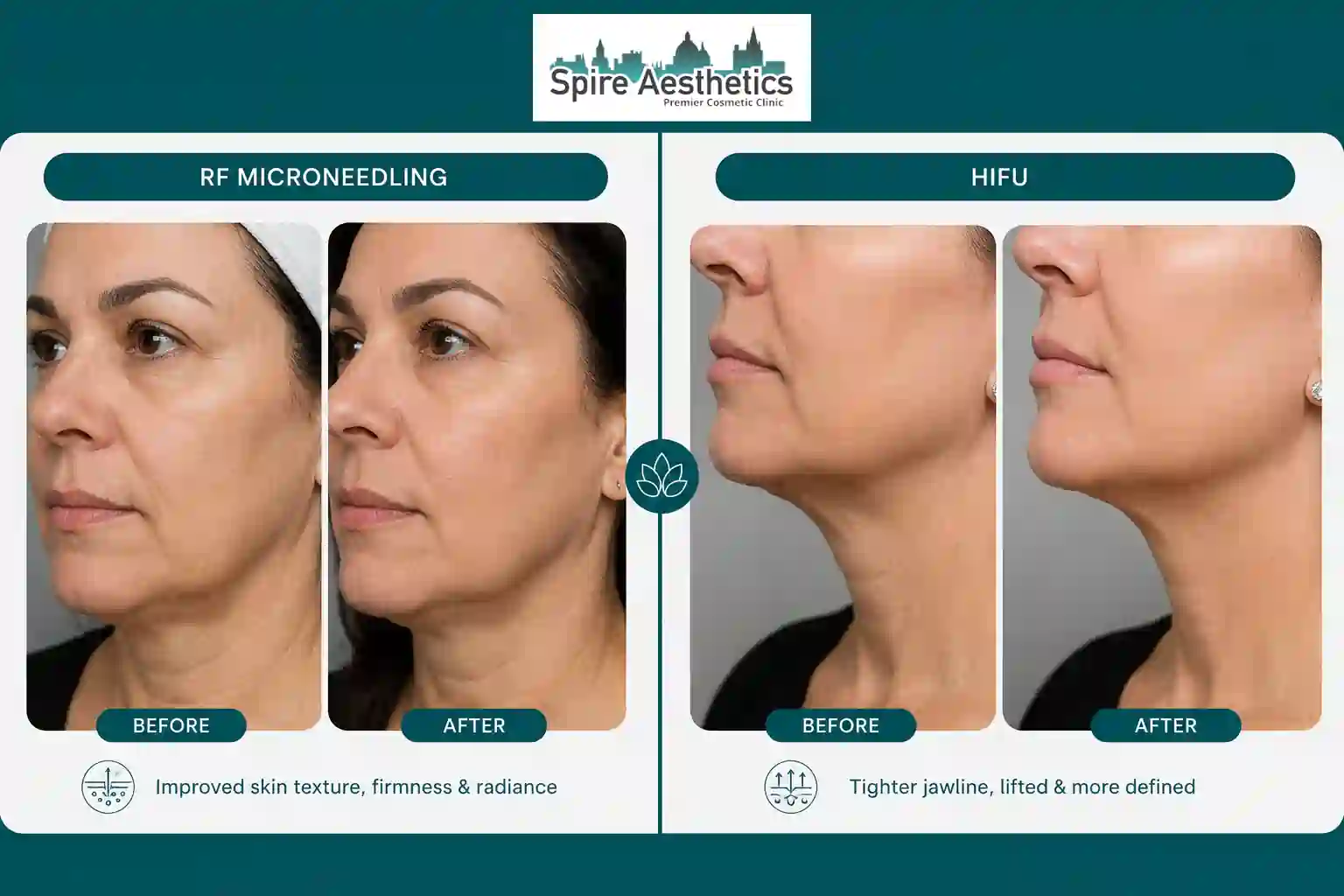 Can RF Microneedling and HIFU Be Combined Epsom?