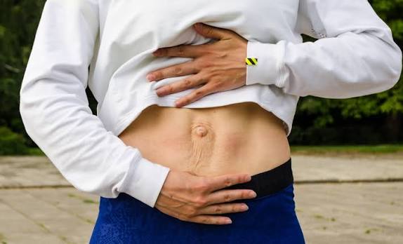When Could Diastasis Recti Be the Missing Piece of the Puzzle Epsom?