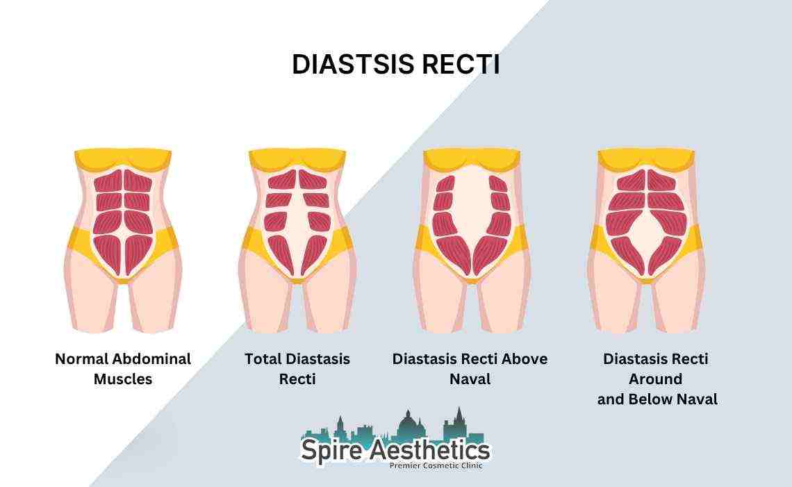 Is Non-Surgical Diastasis Recti Treatment Right for You? Common Concerns Answered Epsom